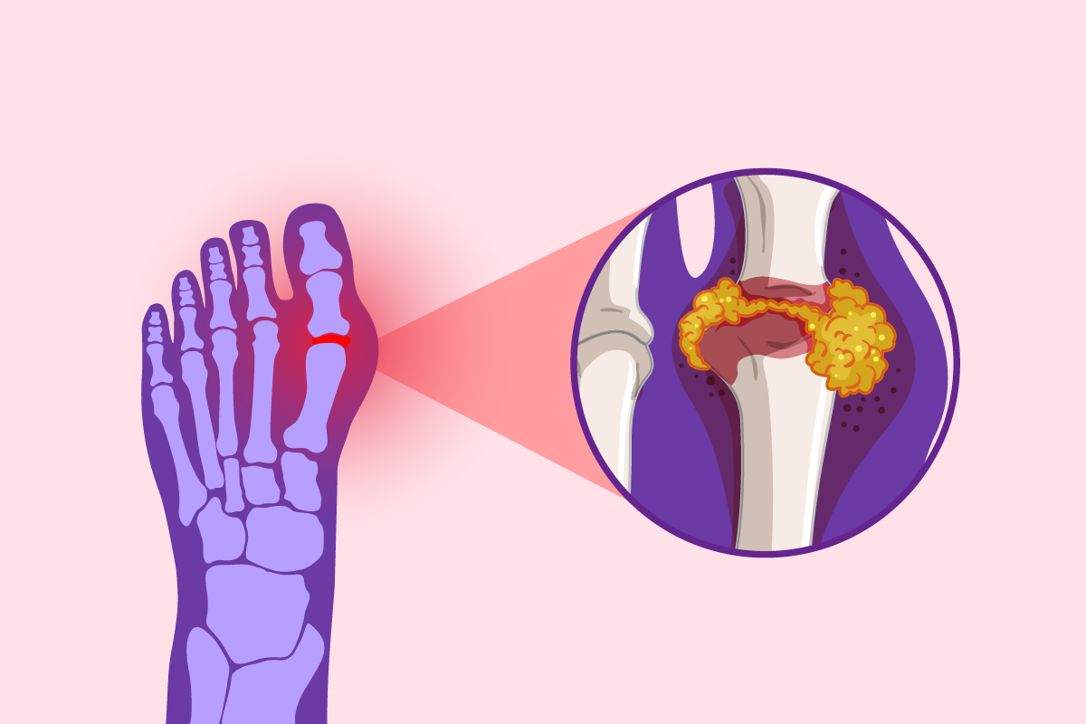 What You Need to Know About Gout